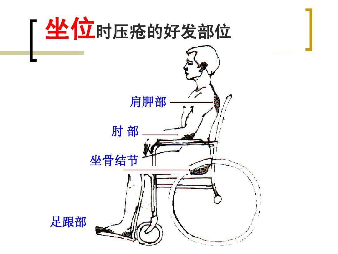 患者取坐位时,最易发生压疮的部位是