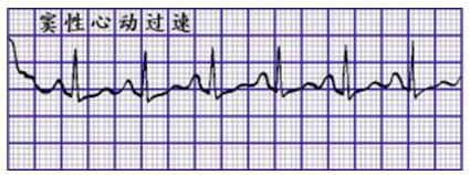 窦性心动过速