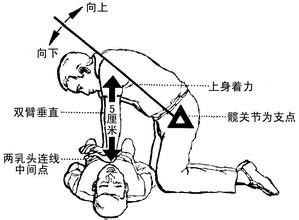 心脏骤停病人的护理考试要点与练习题