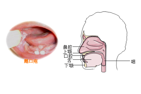 口炎病人的护理考试重点与练习题