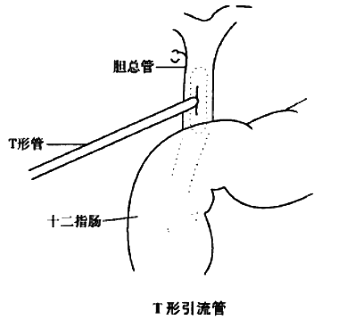 胆石症病人的护理练习题与考试要点