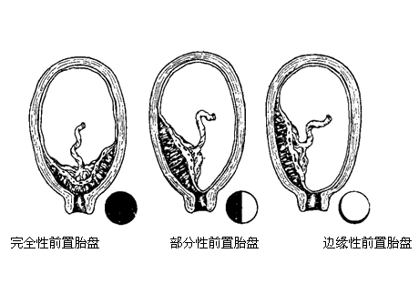 前置胎盘的护理考试要点与练习题