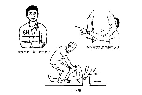 关节脱位相关考点与练习题